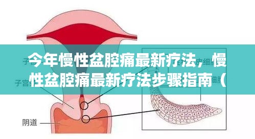 今年慢性盆腔痛最新疗法详解，步骤指南与初学者进阶教程