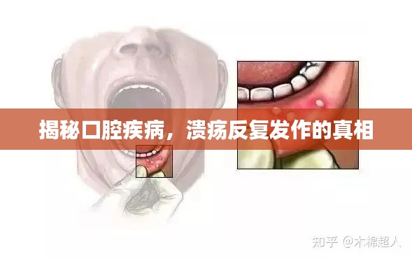 揭秘口腔疾病，溃疡反复发作的真相