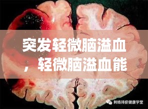 突发轻微脑溢血，轻微脑溢血能自愈吗 