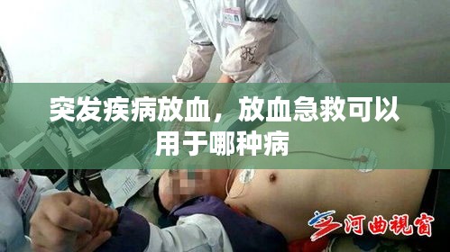 突发疾病放血，放血急救可以用于哪种病 