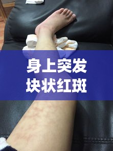 身上突发块状红斑，身上突然出现大块红斑,很痒是怎么回事,是过敏么 